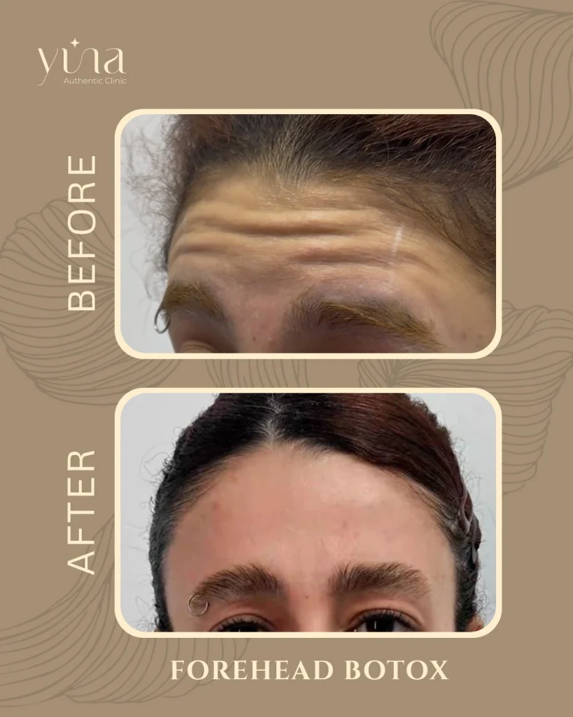 Yina Clinic Forehead Botox Before After